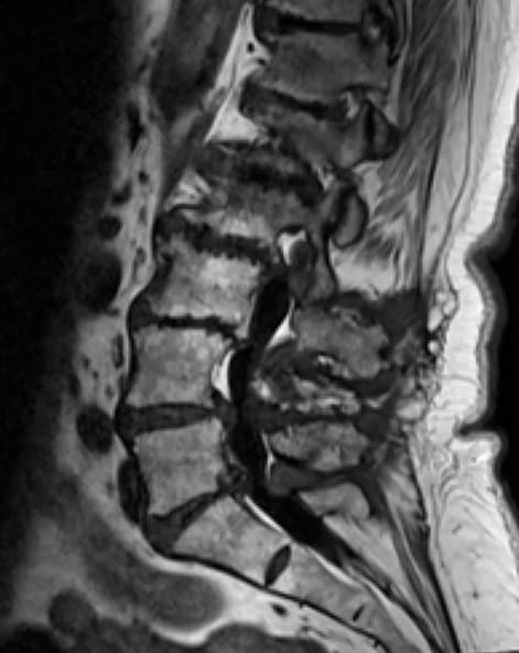 MRI der Lendenwirbelsäule mit markierten Pathologien